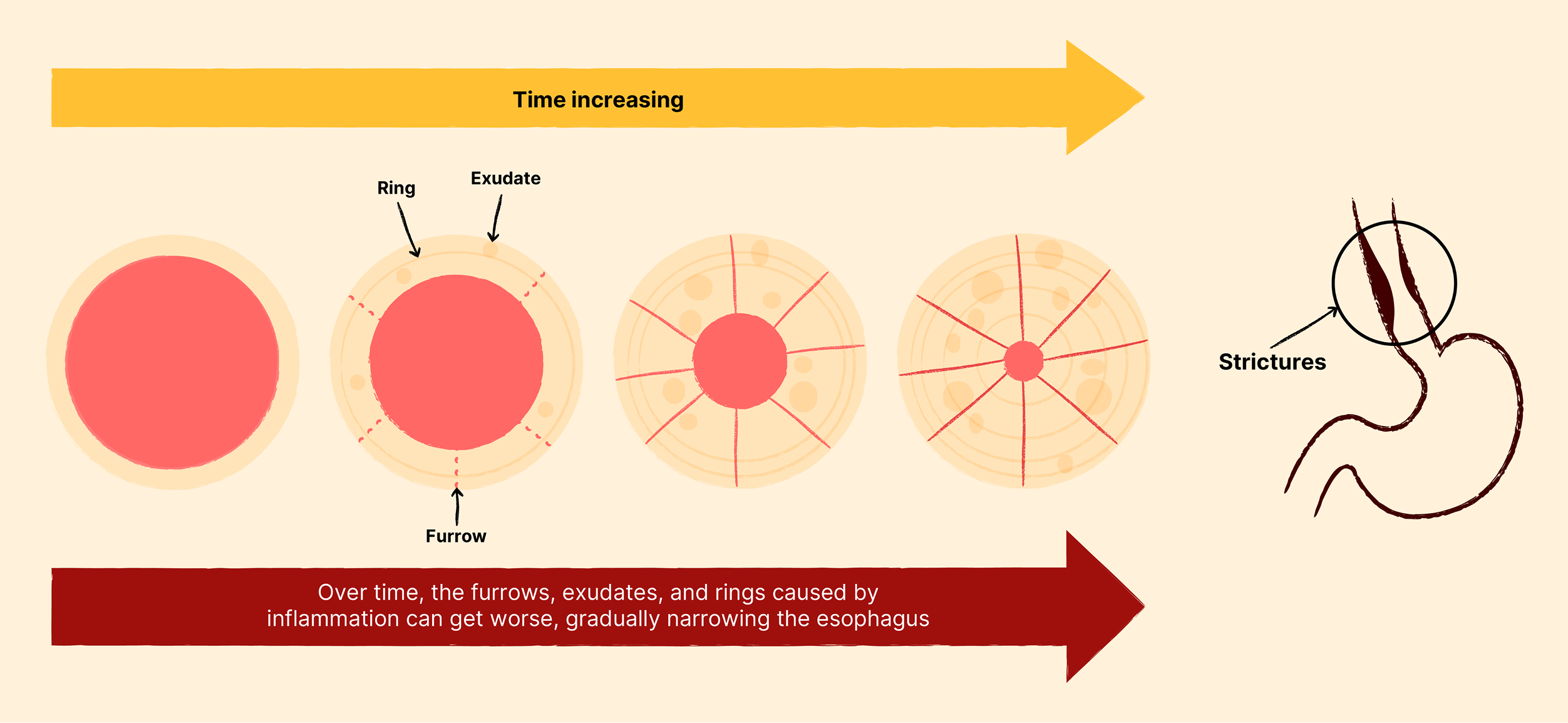 Diagram showing the disease progression of EoE, how over time, the furrows, exudates, and rings caused by the inflammation can get worse, gradually narrowing the esophagus